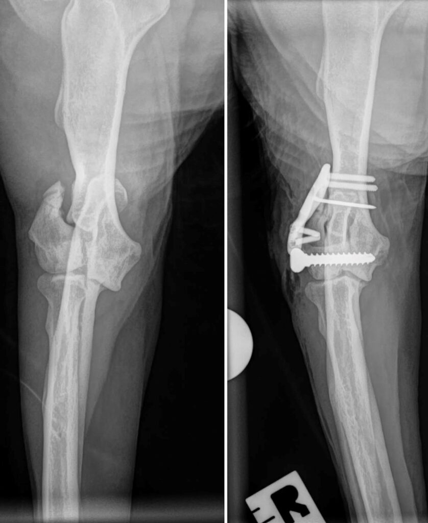 Elbow fracture procedure